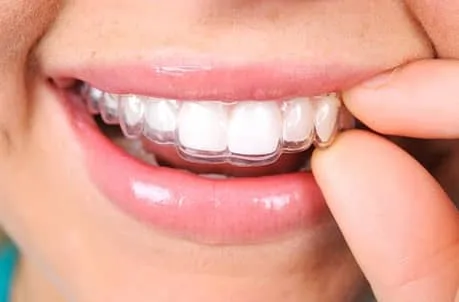 Close up photograph of smiling person wearing Invisalign, Durham, NC