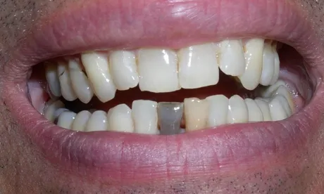 tooth_bleaching1.JPG