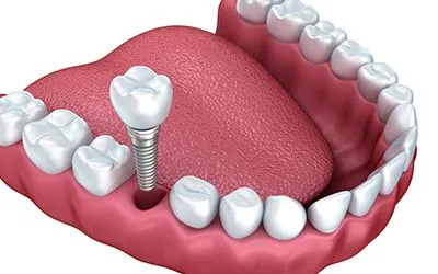 dental implant