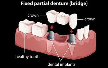 bridges-and-partial-dentures