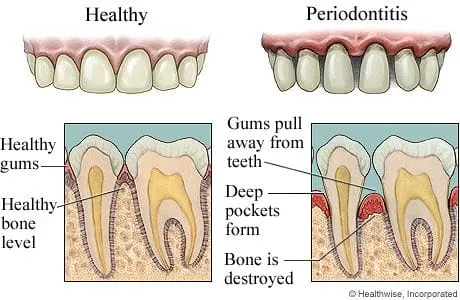periodontal disease nh dentist
