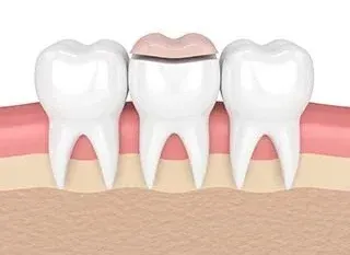 illustration of teeth, dental onlay being placed over one tooth, dentist San Diego, CA