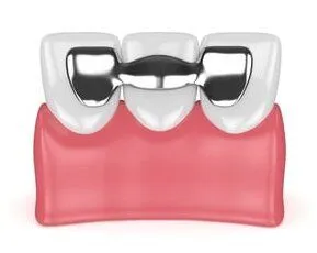 illustration of Maryland style dental bridge, family dentist Lubbock, TX