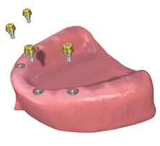 Dental Implants before dentures