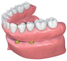 Dentures secured with dental implants