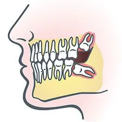 illustration of jaw with teeth, showing impacted wisdom teeth, oral surgeon Beverly Hills, MI oral surgery