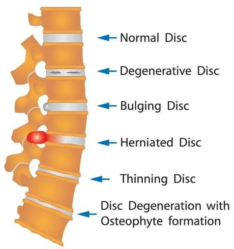 spine map