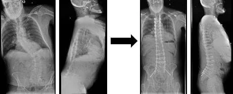 Adult Scoliosis
