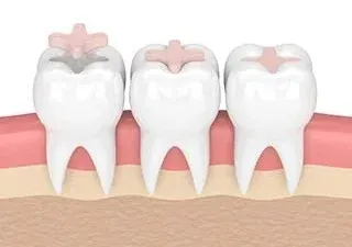illustration of teeth with dental inlay being placed in tooth, dentist downtown San Diego, CA