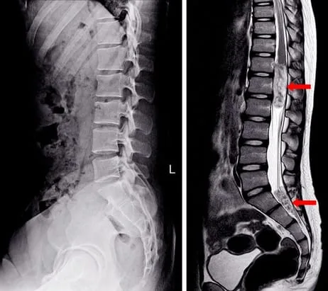 spinal x-ray