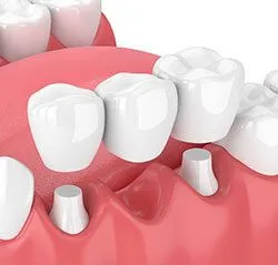 illustration of 3-unit dental bridge being placed in mouth, dental bridge New Baltimore, MI dentist