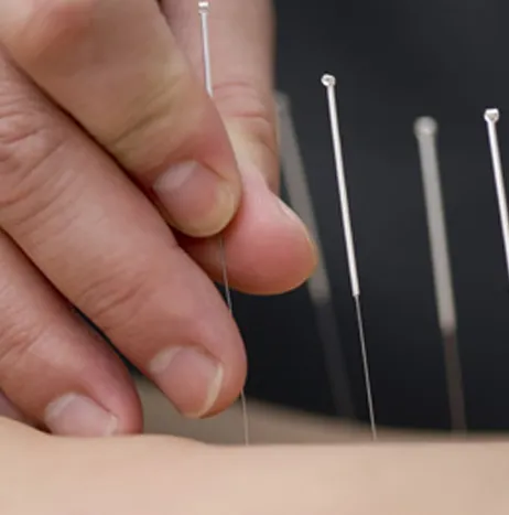 Acupuncture & Dry Needling Therapy
