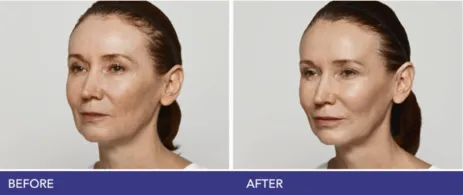 Restylane before and after
