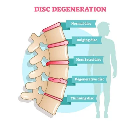 Disc Degenerative medical illustration 