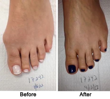 Cosmetic Foot Surgery Before and After 1