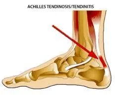 Achilles_Tendonitis.jpg