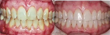 Teeth Whitening & Invisalign