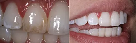 Bonding/Tooth-Colored Fillings