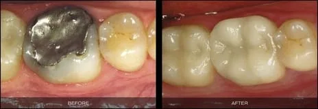 Before and after CEREC Glen Cove NY