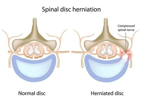 Disc herniation illustration

