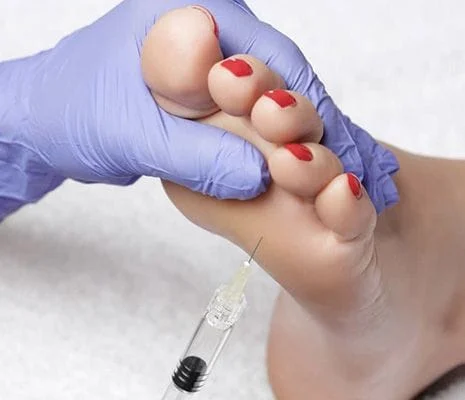 Sweaty Feet Needle Injection