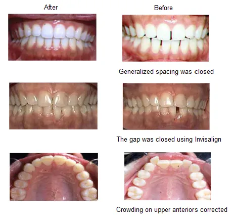images showing results of teeth before and after Invisalign treatment Newark, CA dentist