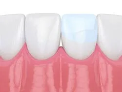 illustration of teeth with bonding on one tooth repairing crack, dental bonding Rocky River cosmetic dentistry