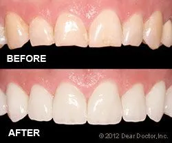 Veneers In Ridgeland, MS 