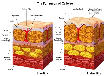 CELLULITE ELIMINATION