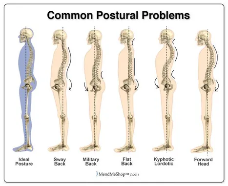 Chiropractor in Matthews, Postural Abnormalities in Matthews