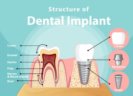 Dental Implant Structure