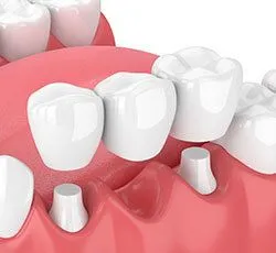 3D illustration showing 3 unit bridge being placed over teeth in mouth, dentist Harrisburg, PA dental bridge