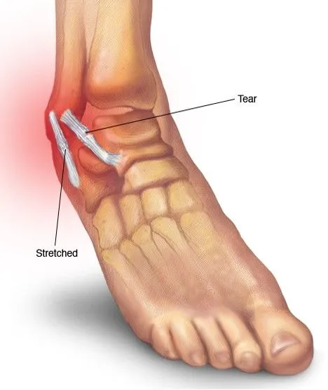 Ankle Sprain