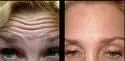 Botox Photo 2