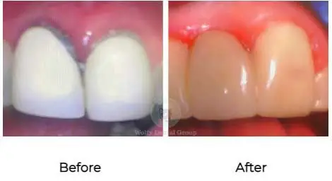 Dental Bridges in Wallingford CT