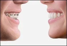 How Does InvisalignÂ® Work?