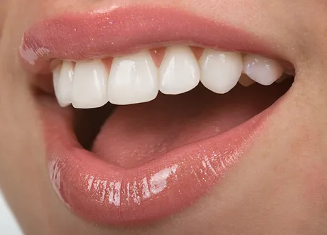 Close up photograph of veneers, Pocatello, ID