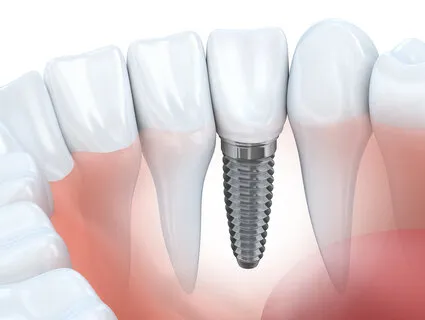 illustration of implant embedded into jaw with natural teeth, dental implants Lincoln, NE dentist