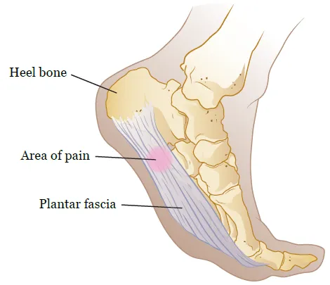 Plantar Fasciitis Scientific Discussion - Anatomy of Plantar Fascia