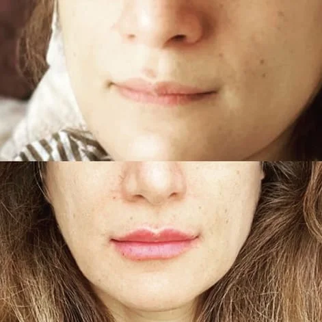 Before_After_EnamelRecontouring