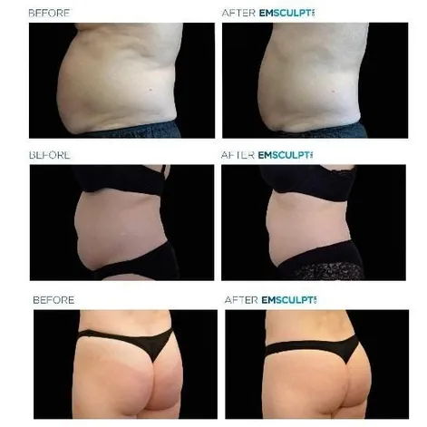 Emsculpt NEO, Dermatologist In Issaquah, WA