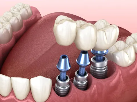 illustration of dental implants screwing into mouth next to real teeth, Franklin, MA dental implants