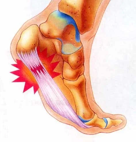 Heel Pain - Brooklyn Premier Orthopedics