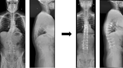 Selective Fusion for Adult Kyphoscoliosis