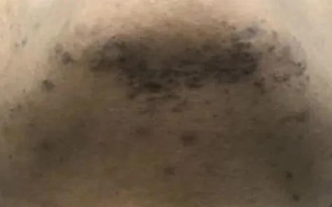 Before Laser Hair Removal