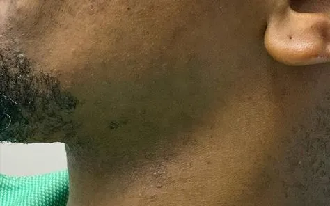 After Laser Treatment