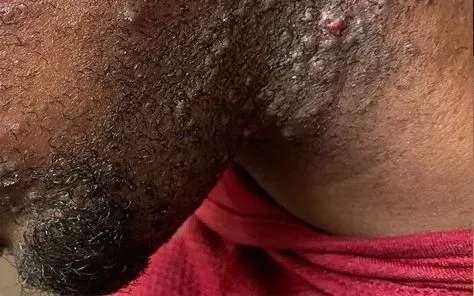 Before Laser Treatment