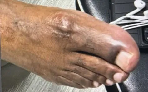 After Laser Treatment