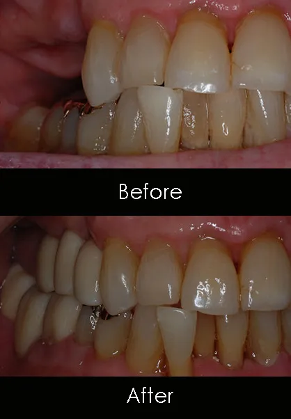 image of teeth before and after dental implants Royal Palm Beach, FL dentist