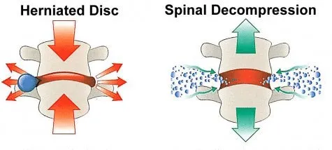 How decompression can help with herniated disc